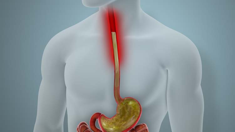 Kronik mide yanması yaşadığını sanıyordu, dördüncü evre kanser çıktı Ölümün kıyısından nasıl döndü