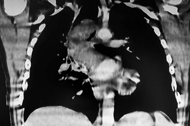 Kronik mide yanması yaşadığını sanıyordu, dördüncü evre kanser çıktı Ölümün kıyısından nasıl döndü