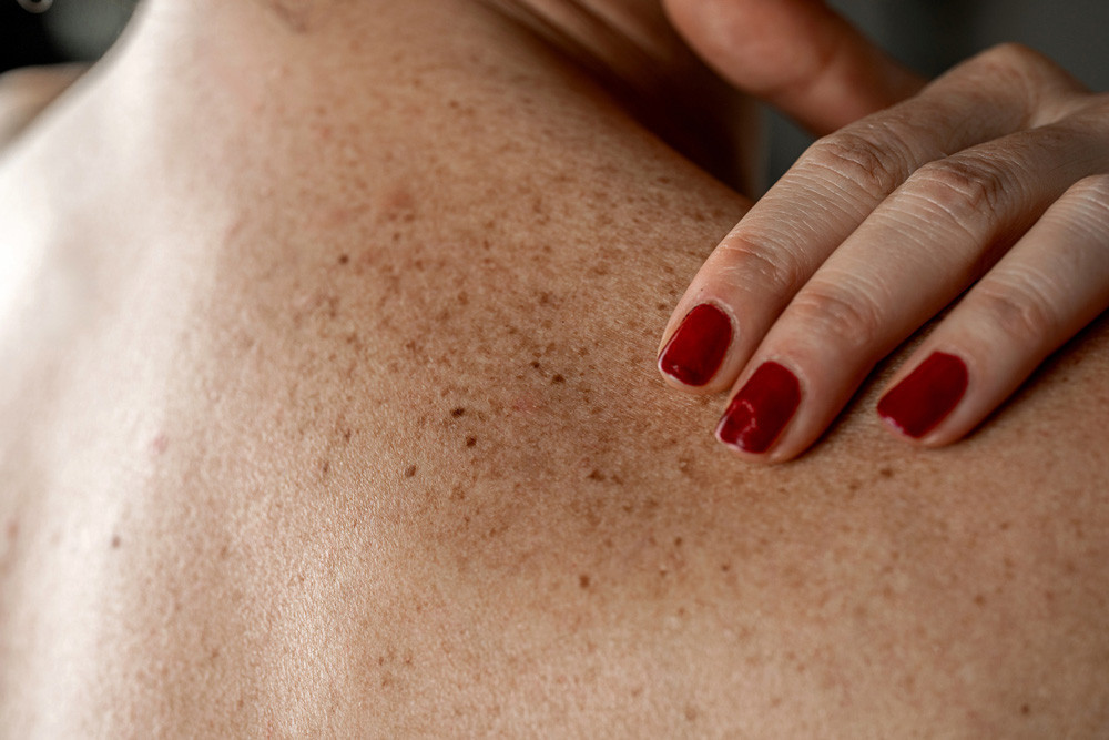 Ciltte böcek geziyormuş hissi Ciltte böcek geziyormuş hissi