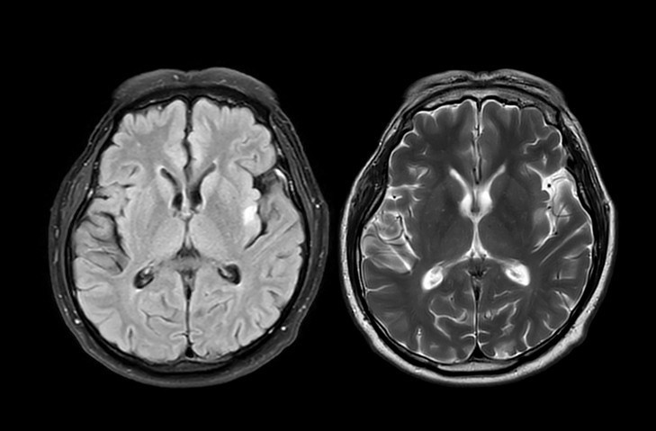 Alzheimer sonunda tarih mi oluyor Hafıza sorunları başlamadan önce sinyal verebilen test geliştirildi Alzheimer sonunda tarih mi oluyor Hafıza sorunları başlamadan önce sinyal verebilen test geliştirildi