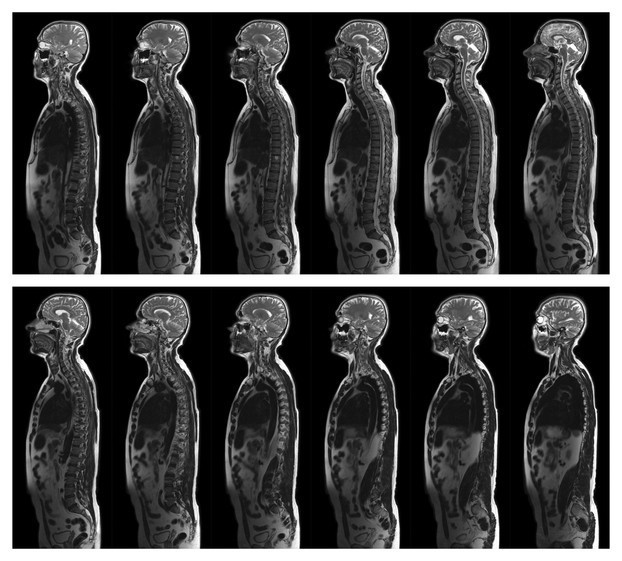 BEL AĞRISI SANILIP GEÇİŞTİRİLEBİLİYOR