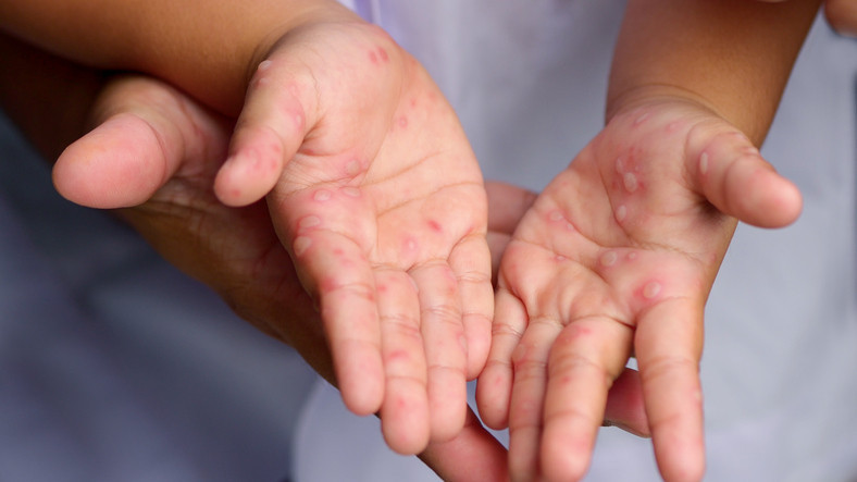 Çocuklarda hızla bulaşıyor