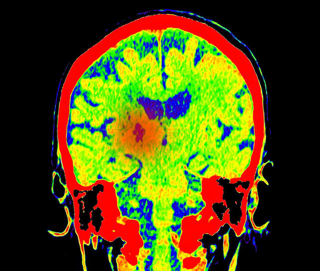 Migren dediler, birkaç hafta ömrü kaldığı ortaya çıktı Genç kız şimdi yaşam savaşı veriyor