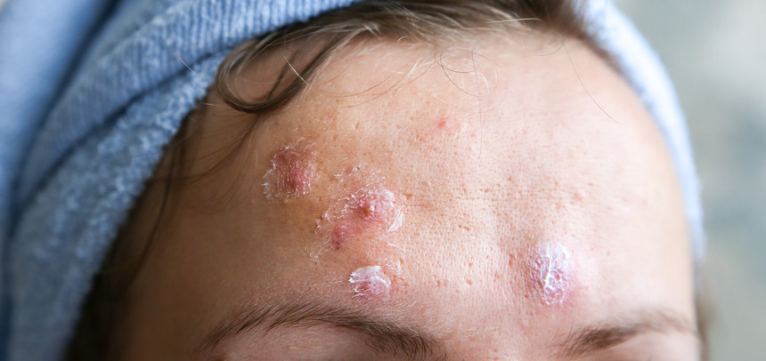  Yüzü tanınmaz hale geldi, 66 gün hastanede kaldı