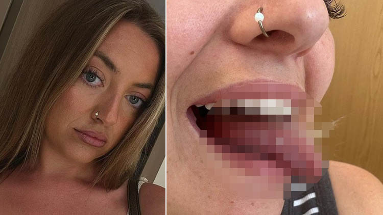 Ağız yarası sanıldı, kanser çıktı! 25 yaşındaki genç kadının dili için kritik ameliyat kararı