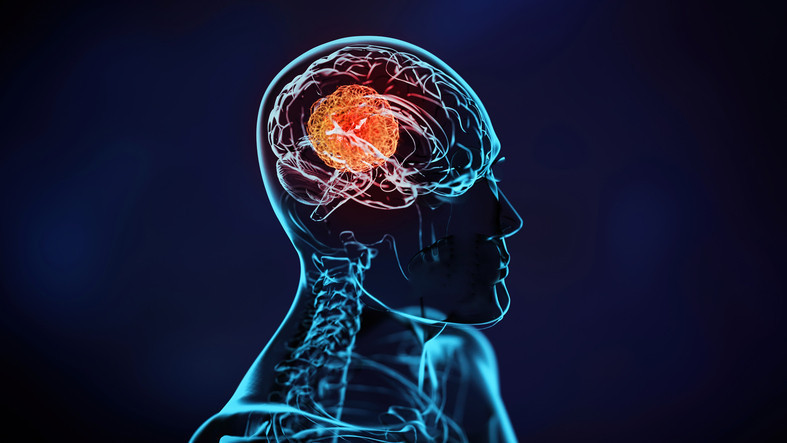 Baş ağrısı ve unutkanlığı hafife almayın Altından bir tümör çıkabilir