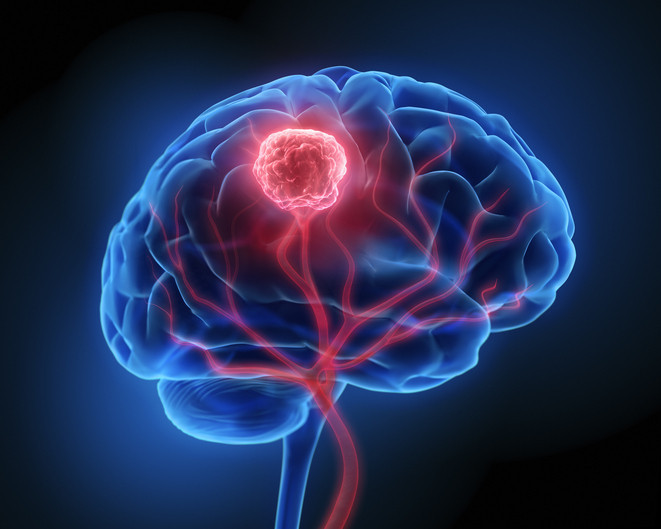 Baş ağrısı ve unutkanlığı hafife almayın Altından bir tümör çıkabilir