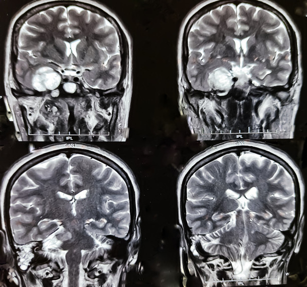 Baş ağrısı ve unutkanlığı hafife almayın Altından bir tümör çıkabilir
