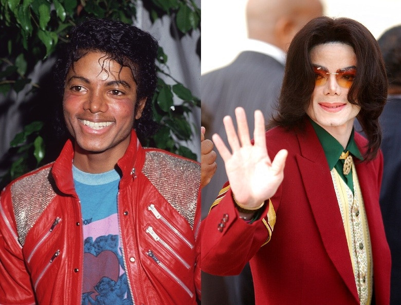 Michael Jackson’ın görüntüsünü değiştiren hastalık yeniden gündemde: Vitiligo nedir, kimleri etkiler?