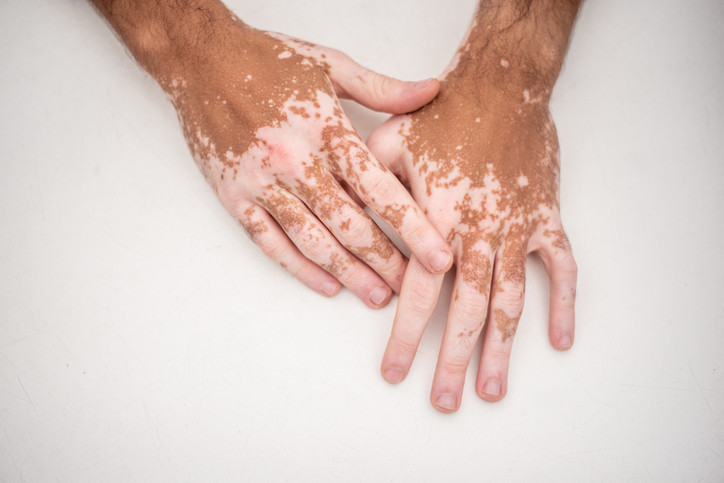 Michael Jackson’ın görüntüsünü değiştiren hastalık yeniden gündemde: Vitiligo nedir, kimleri etkiler Michael Jackson’ın görüntüsünü değiştiren hastalık yeniden gündemde: Vitiligo nedir, kimleri etkiler