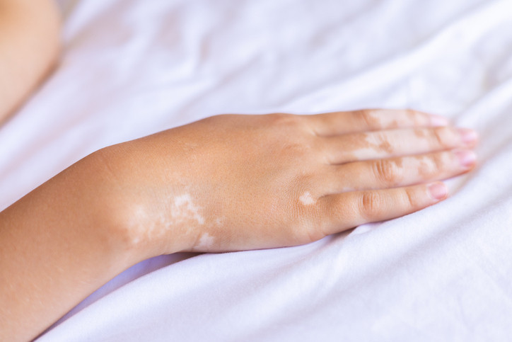 Michael Jackson’ın görüntüsünü değiştiren hastalık yeniden gündemde: Vitiligo nedir, kimleri etkiler Michael Jackson’ın görüntüsünü değiştiren hastalık yeniden gündemde: Vitiligo nedir, kimleri etkiler