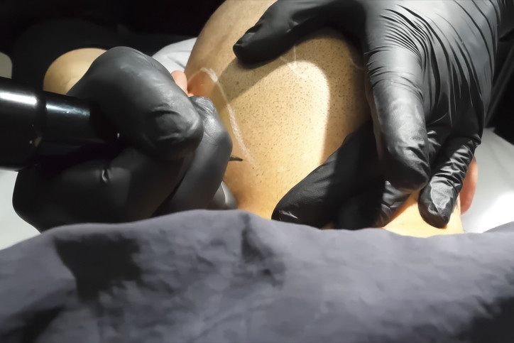 Saç ekimine alternatif yeni yöntem Giderek yaygınlaşıyor, değişim birkaç saatte görülüyor Saç ekimine alternatif yeni yöntem Giderek yaygınlaşıyor, değişim birkaç saatte görülüyor
