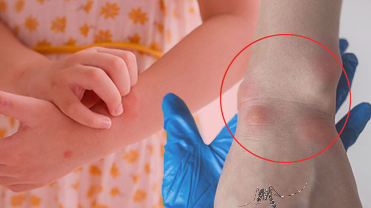 Dr. Turan: West Nile virus in Greece threatens Turkey