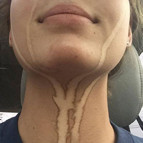 Bronzlaşma faciaları