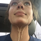 Bronzlaşma faciaları