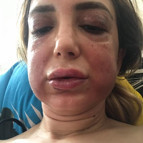 Estetik mağduru kadının yüzü tanınmaz hale geldi