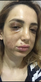 Estetik mağduru kadının yüzü tanınmaz hale geldi