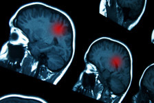 14 yaşındaki gence ‘normal’ denilen baş ağrılarının sebebi korkunç hastalık çıktı! ‘Ona bir tarama bile yapılmadı'