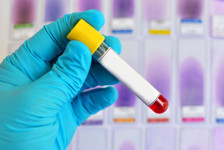Alzheimer riskini öngören yeni bir kan testi yolda! Tam olarak ne zaman hazır olacak?