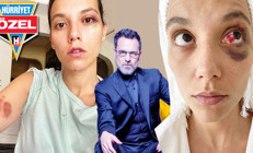 Deniz Bulutsuzun fotoğrafı şok etti: Ozan Güven beni böyle dövdü