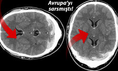 AstraZeneca aşısında flaş gelişme: Yan etkinin gizemini açıkladılar