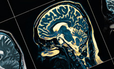 Hasta ve hasta yakını milyonlarca kişiyi ilgilendiriyor... Aşı Alzheimera umut olur mu