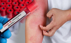 Omicrondan önce bu semptom yoktu Daha çok çocukları etkiliyor: El ve ayaklara dikkat