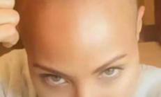 Alopesi (saçkıran) nedir Will Smith’in eşi Jada Smithin hastalığı alopesi hakkında bilgiler…