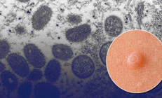 Önce Avrupa, şimdi ABD… Yeni salgın korku yarattı