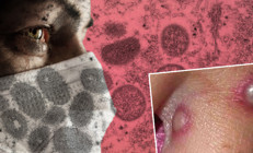 Maymun çiçeği virüsü 4 ülkeye daha sıçradı... CDCden flaş açıklama geldi