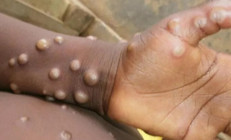 Tek tek açıklandı: Maymun çiçeği hangi ülkelerde görüldü Toplam vaka sayısı kaç