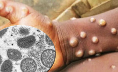 Maymun çiçeği için ilk zorunlu karantina kararı geldi...