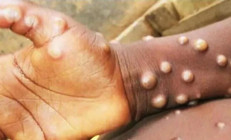 Maymun çiçeği virüsü nedir, nasıl bulaşır, belirtileri neler