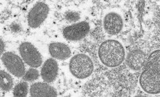 Maymun çiçeği virüsü: Afrika dışındaki vaka sayısı üçe katlanarak 780’e yükseldi