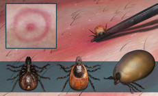 Yüzlerce hastalığı taklit ediyor, dünyanın yaklaşık yüzde 15ini etkiledi Lyme hakkında her şey...