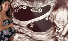 Ultrasona giren anne adayı hayatının şokunu yaşadı 70 milyonda bir görülüyor...