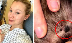 Kafasında çıkan benler için mantar teşhisi aldı, gerçek hastalığının melanom olduğu ortaya çıktı