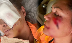 Şilede korkunç olay Ünlü mankene köpek saldırdı