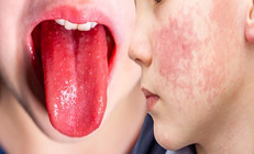 Strep A alarmı bitmeden kızıl endişesi başladı Türkiye’de görülüyor mu Belirtileri neler | 8 SORU 8 YANIT