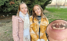 Danimarkalı ikizlerin diş tedavisi kabusa döndü Dişlerinden oldular