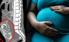 9 yıl bilmeden karnında taşıdı, hayatını kaybetti Dünyada sadece 290 kişide görüldü...