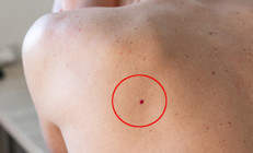 Cilt kanseri neden erkekler için daha ölümcül ‘Özellikle partneri olmayanlar risk altında’