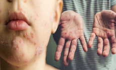 Dikkat, el ayak ağız hastalığı artıyor Özellikle çocukları hedef alıyor... ‘Sıkça karşılaşmaya başladık, çok çabuk bulaşıyor