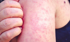 10 SORUDA KIZAMIK DOSYASI I Çocuklardan sonra yetişkinler de risk altında Peki nasıl korunacağız