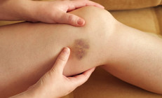 ‘Hiçbir yere çarpmadım, nereden çıktı bu morluklar’ Çoğumuz yaşıyor ve önemsemiyoruz ama altından ciddi bir hastalık çıkabilir