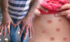 Yaşadığı semptomlar korkuttu: Dokuz gündür M-Çiçeği virüsüyle mücadele ediyor ‘O kadar ağrıyor ki uyuyamıyorum’