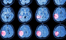 Spordan çıktı, arkadaşlarıyla kahve içerken bir anda yere yığıldı ve hayatının bir yılı silindi… ‘Dişlerimi fırçalamayı, saçlarımı yıkamayı bile unutuyorum’