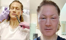 Tüm servetini genç kalmak için harcıyor… ‘Vampir milyoner’ tanınmayacak hale geldi