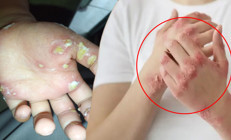 Soğuk havayla birlikte artmaya başladı Tedaviye dirençli vakalar korkuttu… 5-10 dakikada bulaşıyor