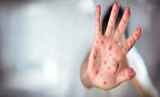 ABDde kızamık alarmı: Vaka sayısı 624e yükseldi